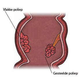 Poliep rectum vlak en gesteeld Genaamd