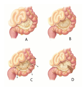 Dicerticulitis