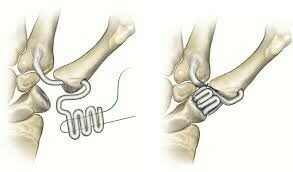 Trapezectomie